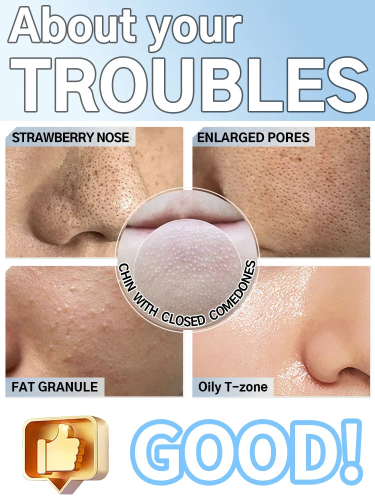 Blackhead Remover pimples and blackheads vacuum pores removal  facial skin cleansing device For Deep cleaning home